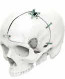 Sterile Cranial Bone Flap Fixation Plate Screw