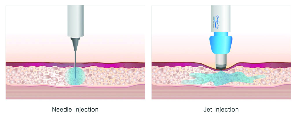 Mature tube needle