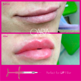 Made in Korea CARA hyaluronic acid CE certified HA filler dermal filler for lip and nose filling
