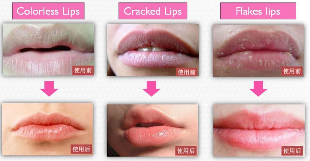 Effect of lip patch