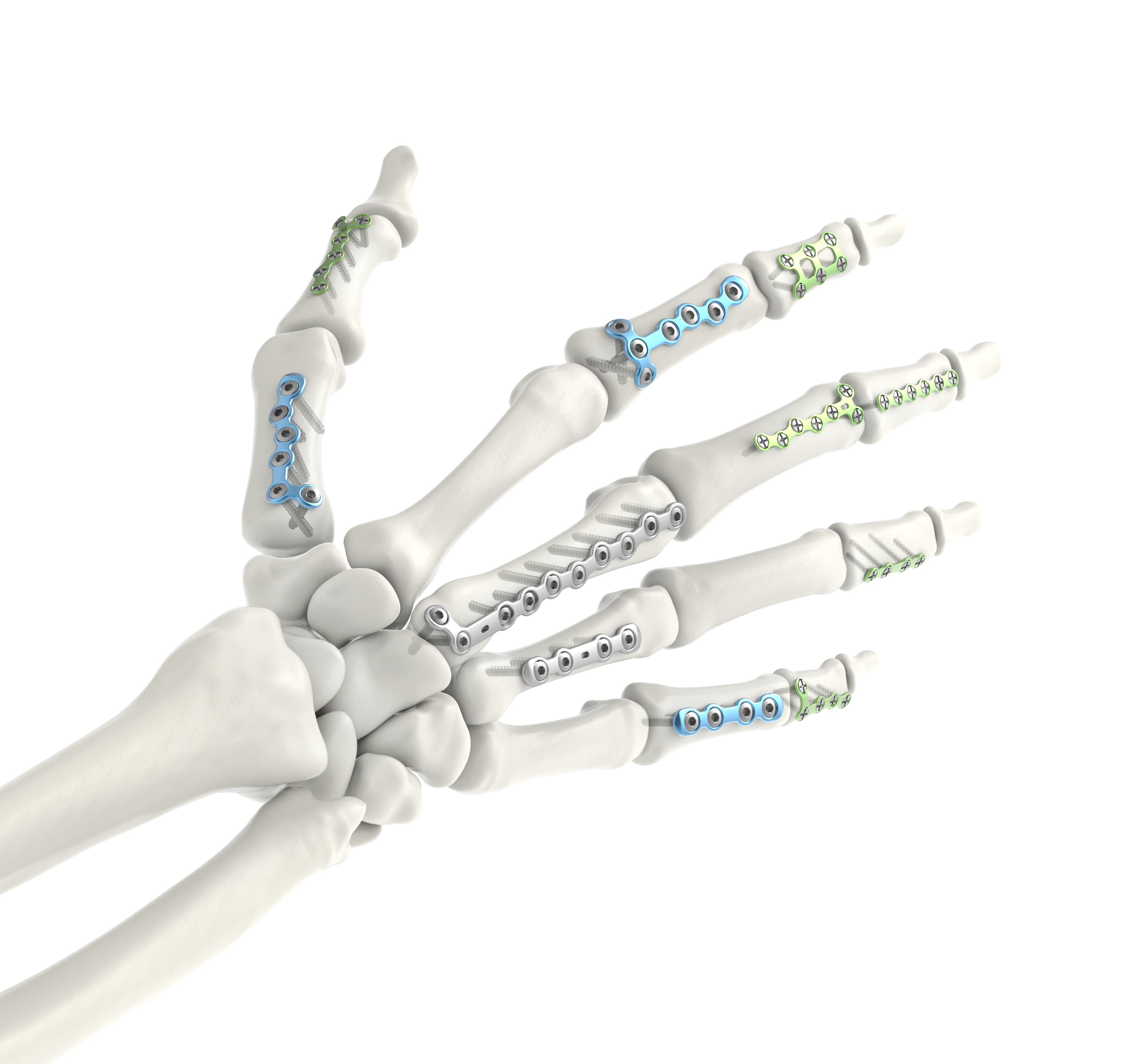 Hand Fracture Fixation Plating System