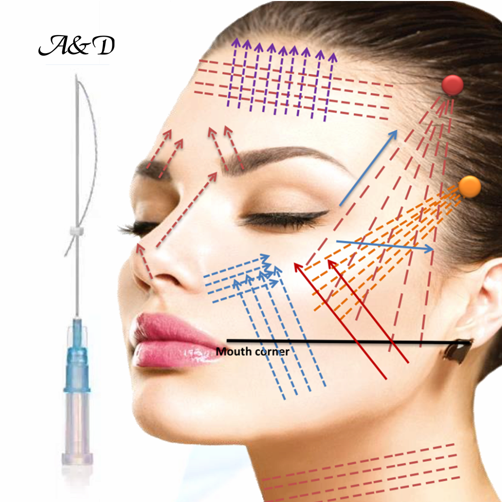 Medical cosmetology pdo hilo lift thread from Remarss | tradekorea