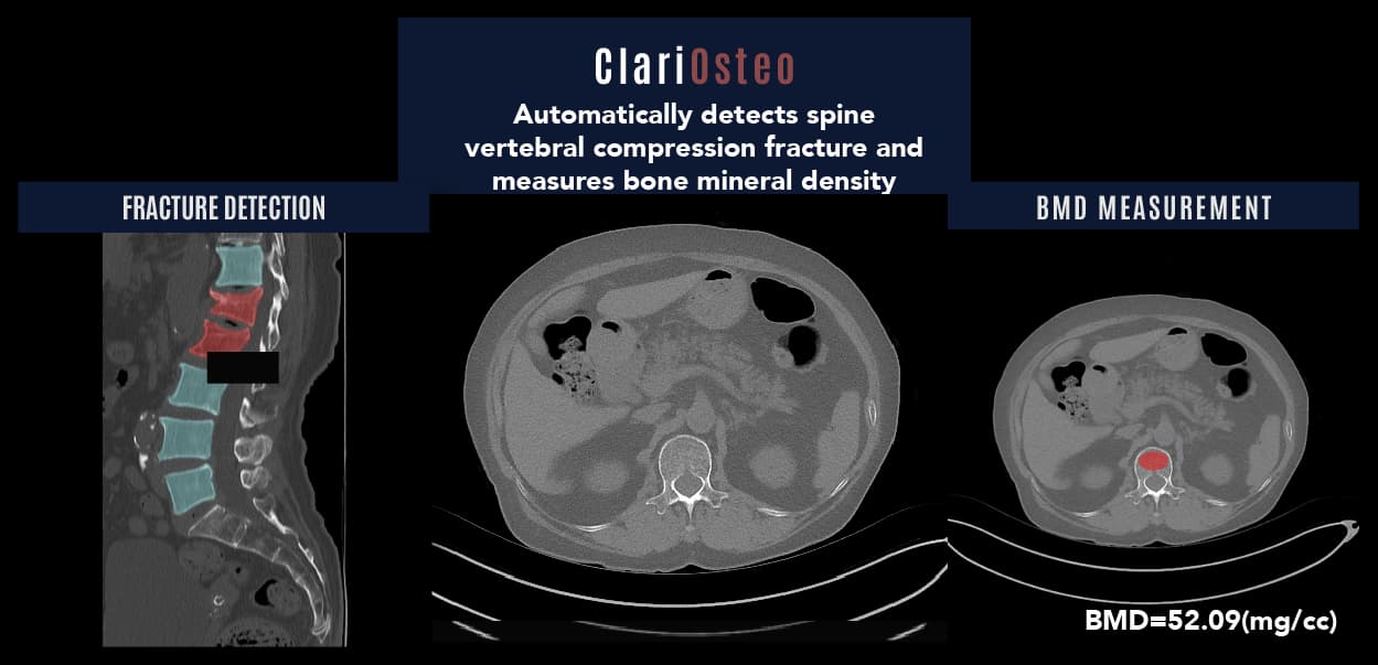 ClariOsteo_AI powered precision bone health care solution with low dose CT
