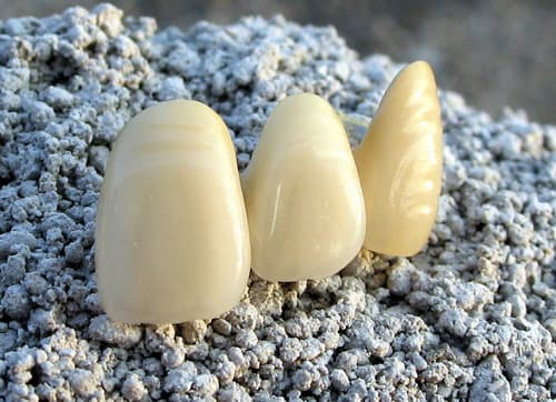 Porcelain fused to metal Tooth